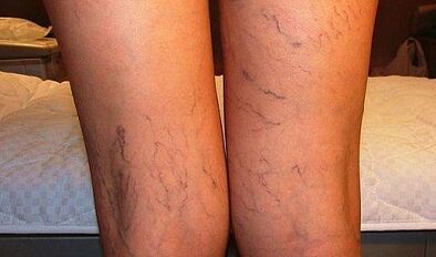 Symptome von Krampfadern bei Frauen