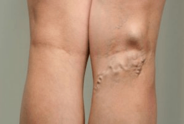 Diagnose von Krampfadern bei schwangeren Frauen