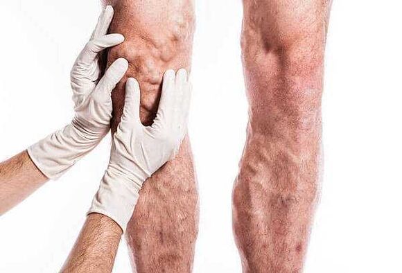 Palpation von Krampfadern an den Beinen
