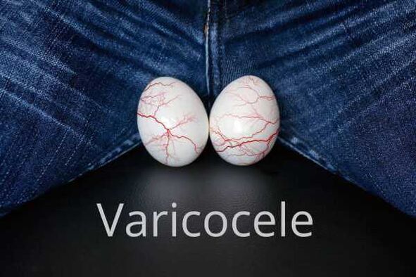 Varikozele – Erweiterung der Samenstrangvenen